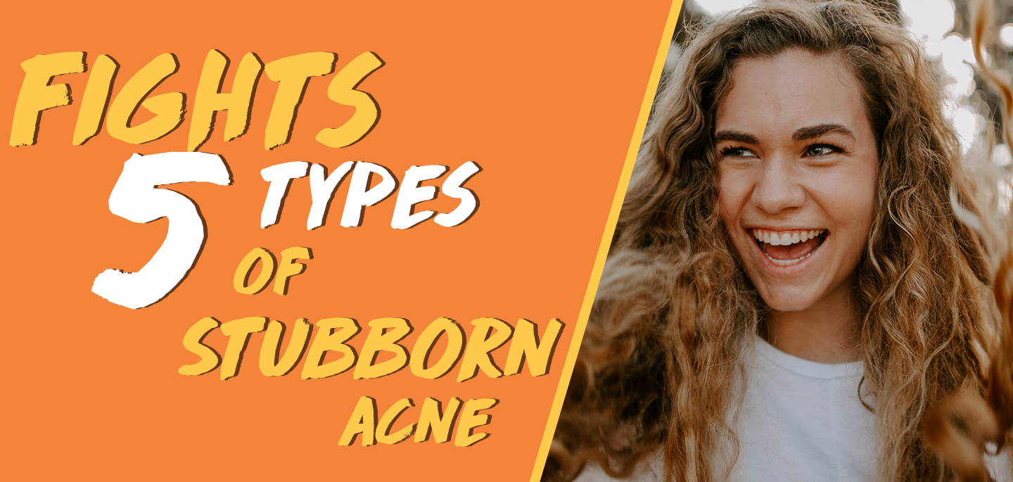 fights 5 types of stubborn acne