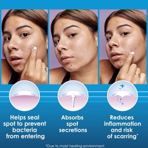 Clearasil Day and Night Spot Patches, Advanced Healing Hydrocolloid Acne Pimple Treatment, Blemish Spot Stickers for Face, 30 Count